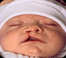 مصرف اسیدفولیک در اوایل بارداری و جلوگیری از شکاف مادرزادی صورت