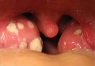 چه موقع لوزه کودک را عمل کنیم؟