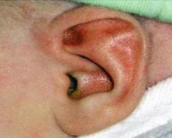 خطر عفونت گوش در کودکان