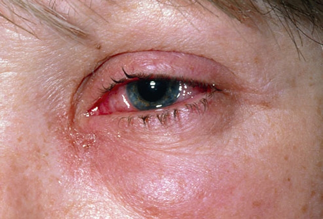 گل مژه چشم چیست و برطرف کردن جوش ها، کبودی و التهابات چشم