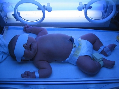 آیا زردی نوزادان خطرناک است؟