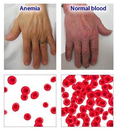 درمان سریع کم‏ خونی با طب پایه سنتی