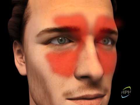 سینوزیت را به روش طب روائی و سنتی پیشگیری درمان کنیم