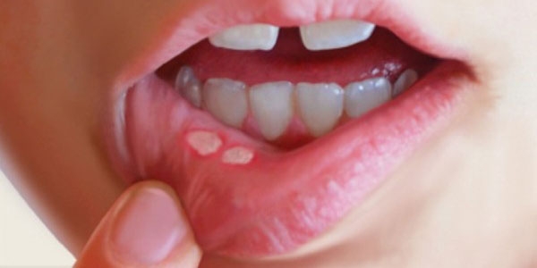 آفت دهانی در کودکان