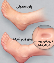 ورم پاها در دوران بارداری