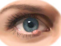 گل مژه، عفونتی در لبه پلک است
