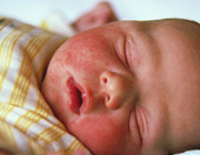  راه درمان اگزمای نوزادان
