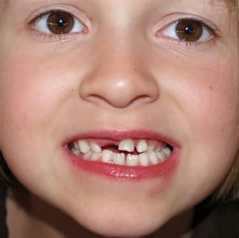 مهمترین عامل پوسیدگی دندان در کودکان 