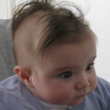 ریزش موی کودک