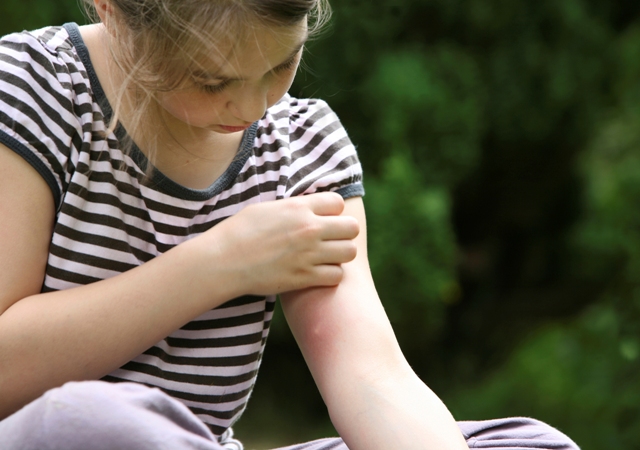 درمان جای نیش حشرات روی پوست کودک