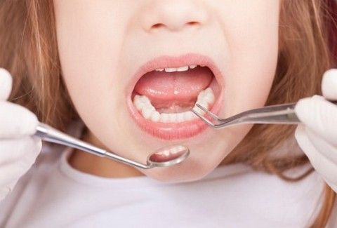 روکش کردن دندان های شیری، چه لزومی دارد؟ 