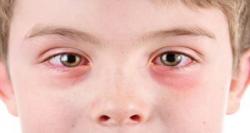  عفونت چشم در کودکان چیست؟