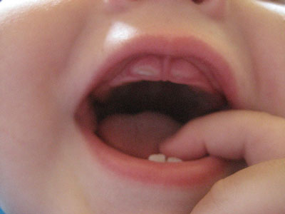 آیا دندان‌های شیری مهم‌اند؟