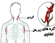 علائم لنفوم شبیه سرماخوردگی است