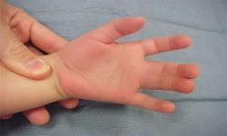  سین داکتیلی یا چسبیده بودن مادرزادی انگشتان دست چیست