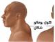  سندرم کوشینگ چیست؟